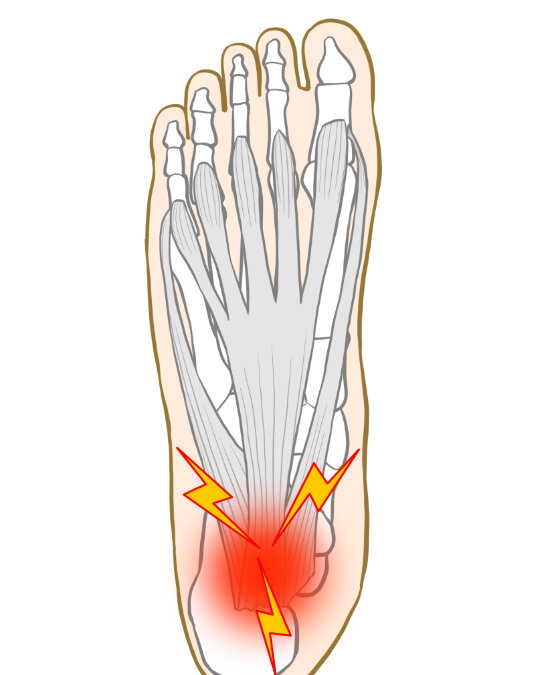 足底腱膜炎かな？と思ったら｜足の裏の痛みでお困りの方は、宜野湾市のさくがわ接骨院